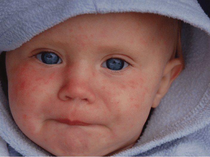 Healthcare professionals support measles vaccination on social media