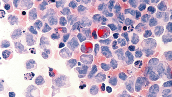 3 reasons for renewed hope in the treatment landscape of acute myeloid leukaemia